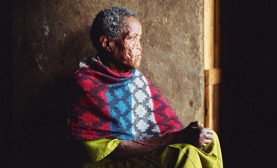 埃塞俄比亚首都亚的斯亚贝巴的一名麻风患者。